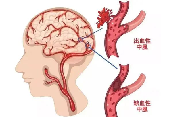 为什么中国脑梗越来越多，美国却在减少？医生：主要原因有这3点